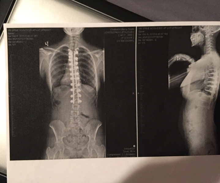 Castile went into surgery to get rods in her back to straighten her back, because of scoliosis.